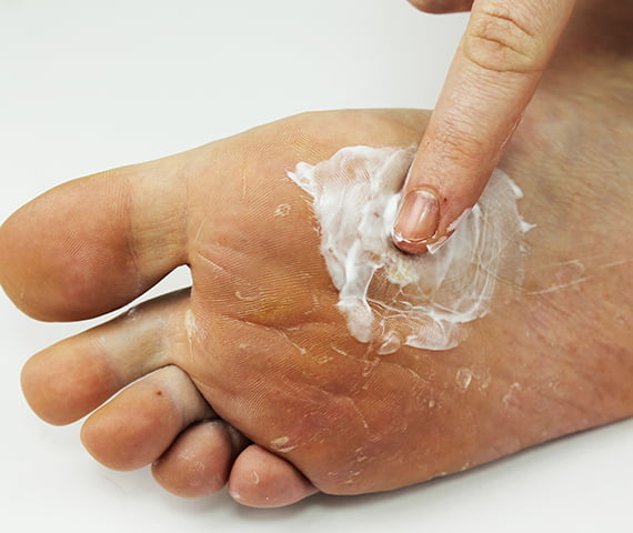 Hand Fuss Syndrom Behandlung